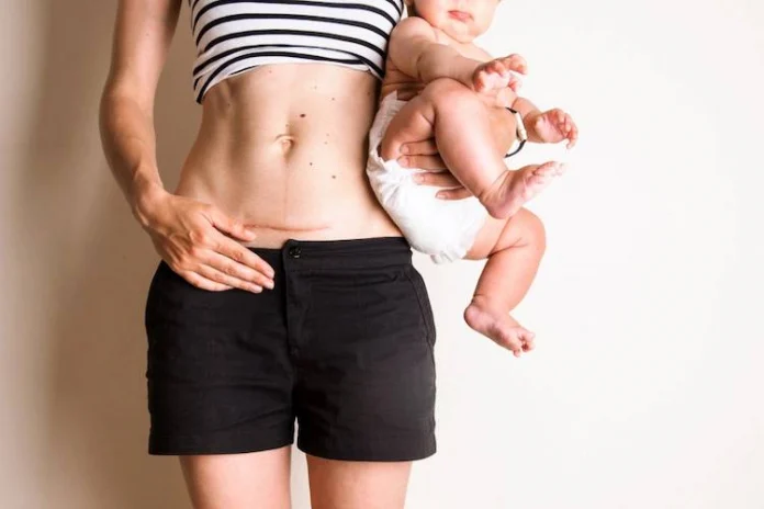 euX Interactive to treat diastasis, without surgical intervention