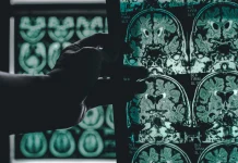 Could your memory lapses be a sign of Alzheimer’s Disease? alzheimer's disease on MRI