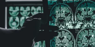 Could your memory lapses be a sign of Alzheimer’s Disease? alzheimer's disease on MRI