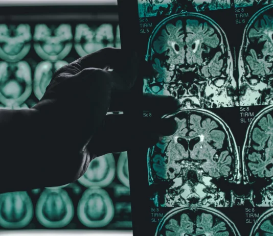Could your memory lapses be a sign of Alzheimer’s Disease? alzheimer's disease on MRI