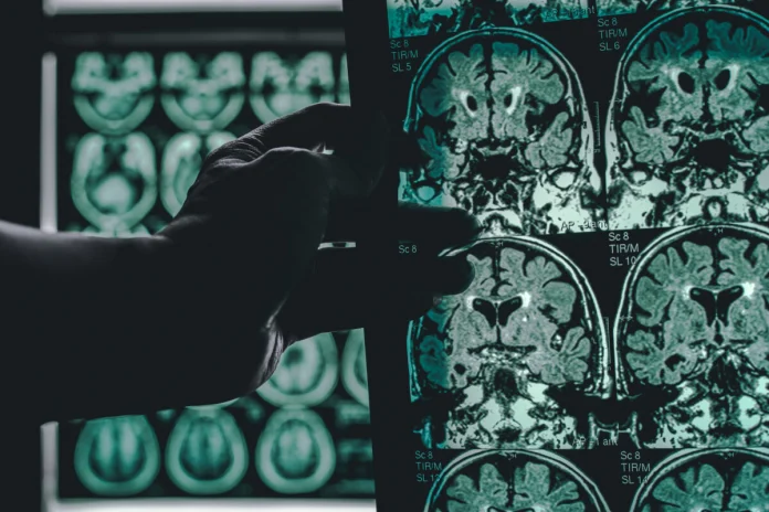 alzheimer's disease on MRI